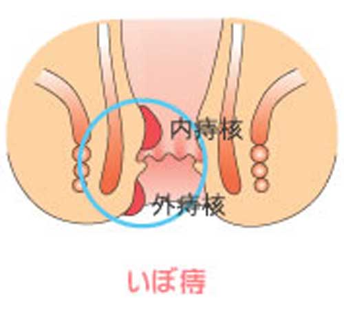 いぼ痔