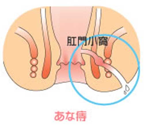 あな痔